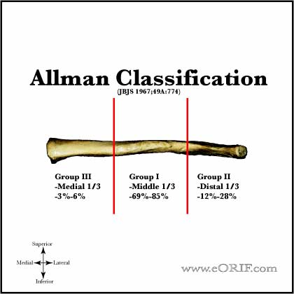 Allman Classification of clavicle shaft fracture