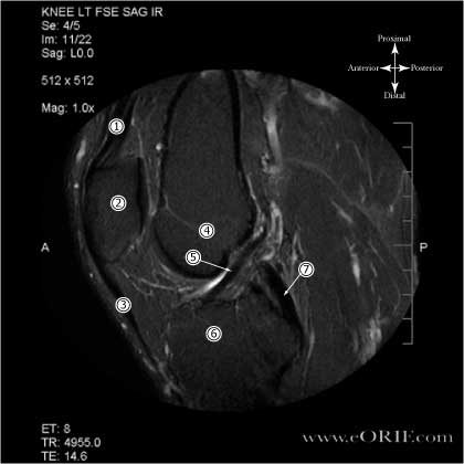 Inversion Recovery MRI of Normal ACL Inversion Recovery MRI of Normal ACL