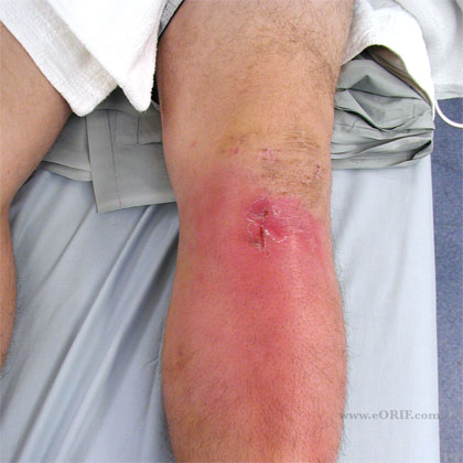 Post op knee infection image Post op knee infection image
