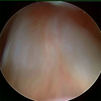 arthroscopic ACL picture arthroscopic ACL picture