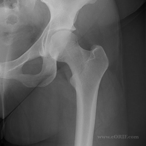 A/P view hip A/P xray view of the hip