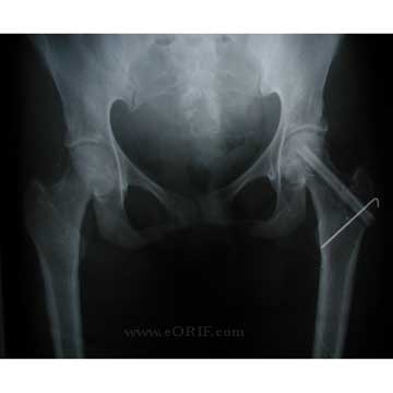 HIP AVN vascularized fibula xray Hip AVN vascularized fibula graft xray