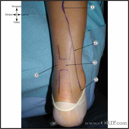 Achilles tendon rupture image
