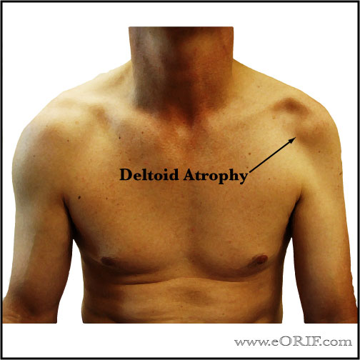 deltoid atrophy picture deltoid atrophy picture