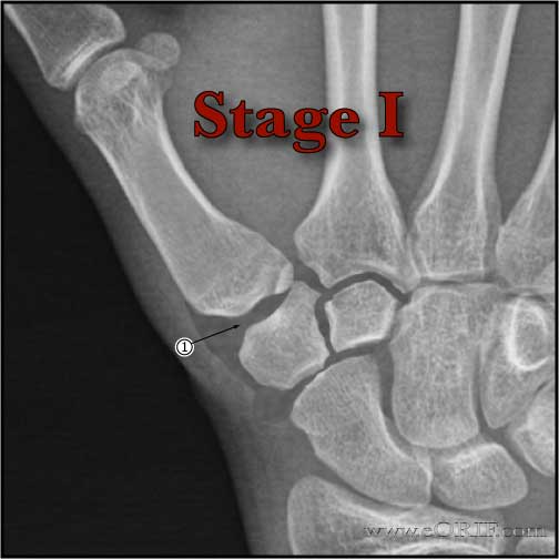 Thumb CMC arthritis Stage 1 xray Thumb CMC arthritis Stage I xray