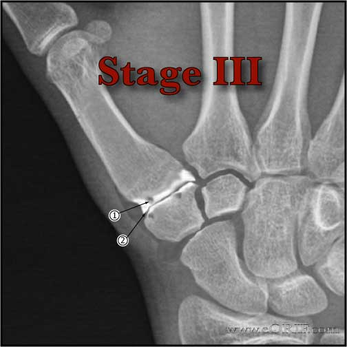 Thumb CMC arthritis Stage 3 xray Thumb CMC osteoarthritis stage III xray