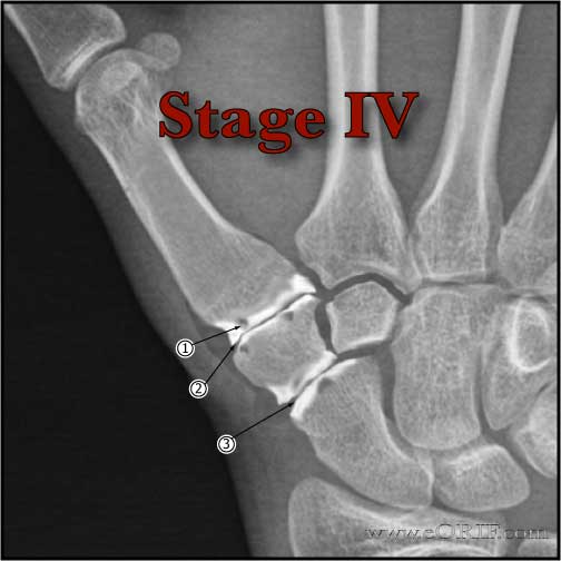 Thumb CMC arthritis Stage 4 xray Thumb CMC osteoarthritis stage IV xray