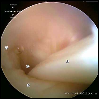 biceps tendon arthrocsopic picture biceps tendon arthroscopic picture