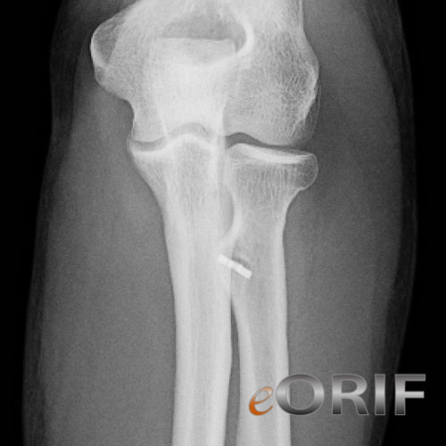 Biomet Toggleloc xray Biomet Toggleloc xray
