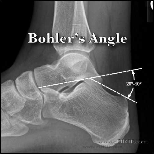 Bohlers angle xray Bohler's angle calcareous xray