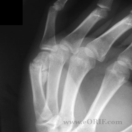 MC neck nonunion xray Metacarpal neck fracture nonunion xray