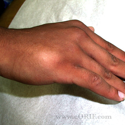 Metacarpal fracture malunion photo Metacarpal fracture malunion photo