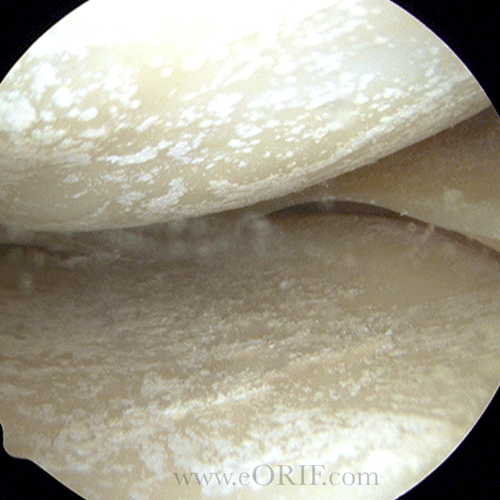 CPPD of the knee image CPPD of the knee arthroscopic image