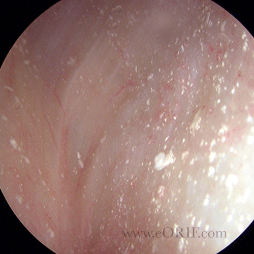 CPPD of the knee image CPPD of the knee arthroscopic image