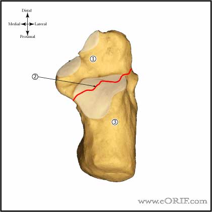 Calcaneous Primary Fracture Line Calcaneous Primary Fracture Line Image