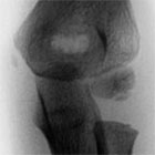 little league elbow xray little league elbow xray