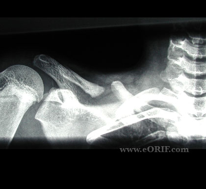 clavicle pseudoarthrosis picture clavicle pseudoarthrosis picture