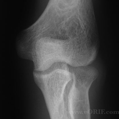 congenital radial head dislocation xray congenital radial head dislocation xray