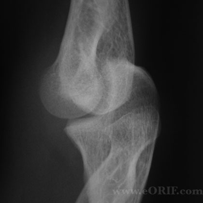 congenital radial head dislocation xray congenital radial head dislocation xray