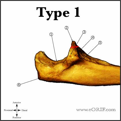 Type I Coronoid Fracture Type I Coronoid Fracture