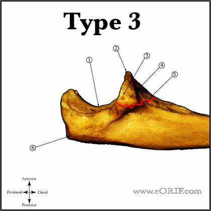 Type III Coronoid Fracture Type III Coronoid Fracture