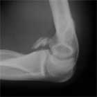 Coronoid fracture Coronoid fracture xray