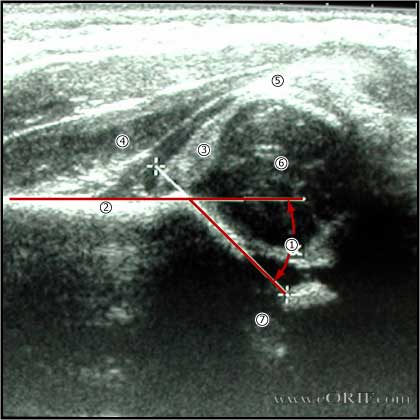 DDH ultrasound picture DDH ultrasound picture