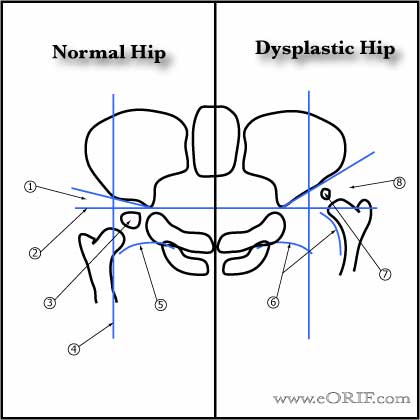 DDH xray landmarks DDH xray landmarks