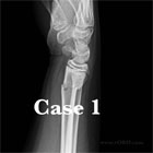 Pediatric distal radius fracture