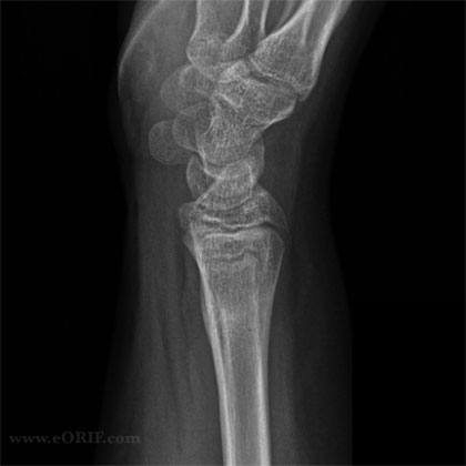 xray distal radius fracture