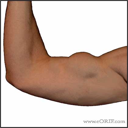 Distal Biceps Tendon Rupture Image distal biceps tendon rupture picture