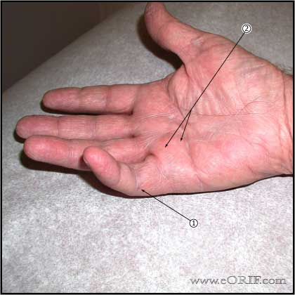 Dupuytren's Contracture Dupuytren's Contracture Picture