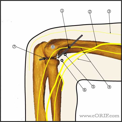 elbow arthroscopy medial portals picture elbow arthroscopy medial portals