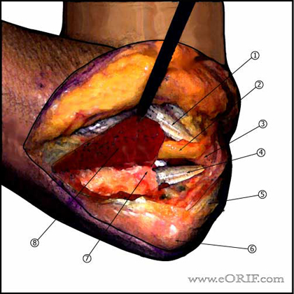 posteromedial approach to the elbow Posteromedial approach to the elbow