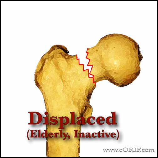 Displaced fermoral neck fracture Displaced fermoral neck fracture