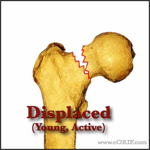 Displaced femoral neck fracture Displaced femoral neck fracture image