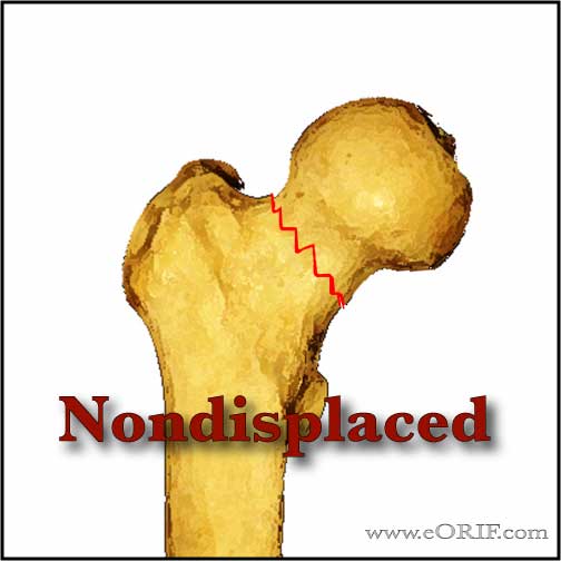 Nondisplaced femoral neck fracture image Nondisplaced femoral neck fracture image