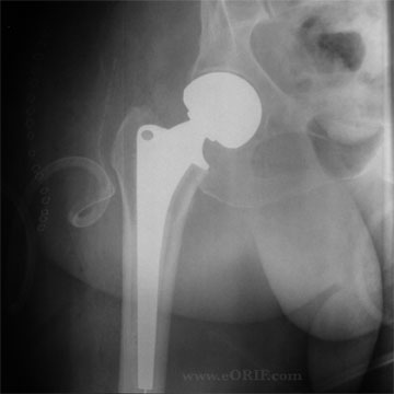 Hip Hemiarthroplasty xray Hemiarthroplasty for femoral neck fracture xray