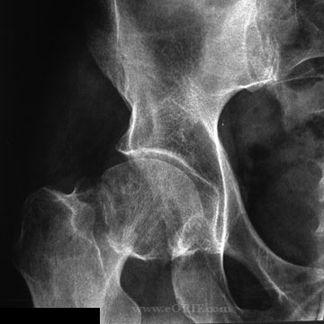 Femoral neck fracture Femoral neck fracture xray