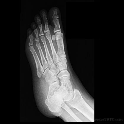 Foot oblique view xray