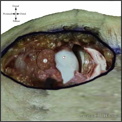 thumb UCL repair picture