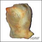 ganglion cyst
