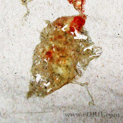 Ganglion cyst fluid image