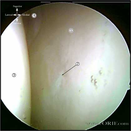 glenoid arthroscopy glenoid arthoscopy