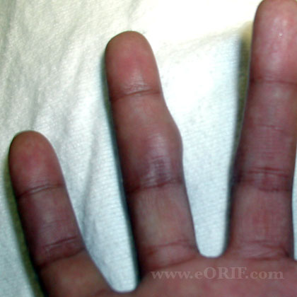 giant cell tumor of the tendon sheath pic