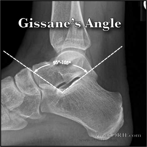 Gissane's Angle