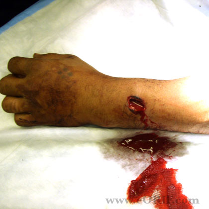 Grade 2 open distal radius fracture pic Grade 2 open distal radius fracture image