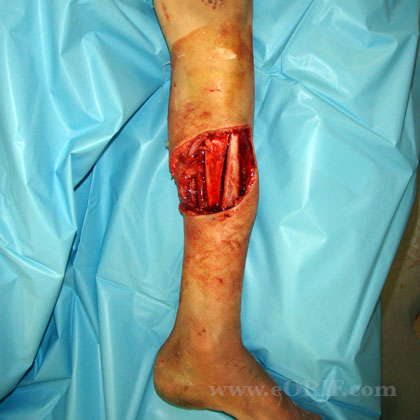 Grade 3A open tibial shaft fracture pic Grade 3A open tibial shaft fracture image