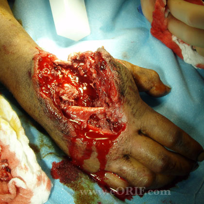 Grade 3B open fracture pic Grade 3B open fracture image