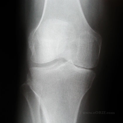 HTO xray HTO xray